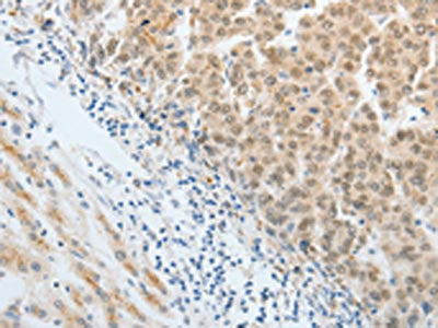 The image on the left is immunohistochemistry of paraffin-embedded Human liver cancer tissue using CSB-PA697958(AKAP8L Antibody) at dilution 1/20, on the right is treated with synthetic peptide. (Original magnification: ×200)
