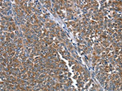 The image on the left is immunohistochemistry of paraffin-embedded Human ovarian cancer tissue using CSB-PA698004(PTRH2 Antibody) at dilution 1/20, on the right is treated with fusion protein. (Original magnification: ×200)