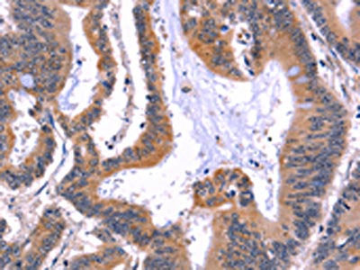 The image on the left is immunohistochemistry of paraffin-embedded Human colon cancer tissue using CSB-PA698018(ARC Antibody) at dilution 1/50, on the right is treated with fusion protein. (Original magnification: ×200)
