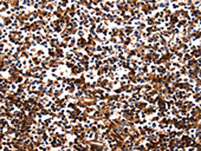 The image on the left is immunohistochemistry of paraffin-embedded Human tonsil tissue using CSB-PA698087(HP Antibody) at dilution 1/25, on the right is treated with fusion protein. (Original magnification: ×200)