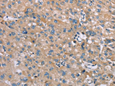 The image on the left is immunohistochemistry of paraffin-embedded Human liver cancer tissue using CSB-PA698102(SAMD9 Antibody) at dilution 1/35, on the right is treated with synthetic peptide. (Original magnification: ×200)