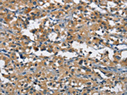 The image on the left is immunohistochemistry of paraffin-embedded Human thyroid cancer tissue using CSB-PA698112(BMPR1B Antibody) at dilution 1/25, on the right is treated with fusion protein. (Original magnification: ×200)