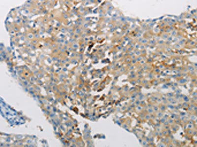 The image on the left is immunohistochemistry of paraffin-embedded Human breast cancer tissue using CSB-PA698191(AATK Antibody) at dilution 1/10, on the right is treated with synthetic peptide. (Original magnification: ×200)
