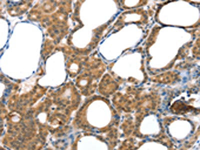 The image on the left is immunohistochemistry of paraffin-embedded Human thyroid cancer tissue using CSB-PA698457(LAMA4 Antibody) at dilution 1/30, on the right is treated with fusion protein. (Original magnification: ×200)