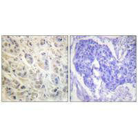 Immunohistochemistry analysis of paraffin-embedded human colon carcinoma tissue using p90 RSK (Ab-573) antibody.