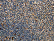 The image on the left is immunohistochemistry of paraffin-embedded Human tonsil tissue using CSB-PA698514(GGT1 Antibody) at dilution 1/40, on the right is treated with fusion protein. (Original magnification: ×200)
