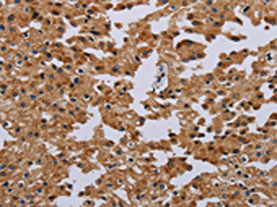 The image on the left is immunohistochemistry of paraffin-embedded Human prostate cancer tissue using CSB-PA698625(IFRD1 Antibody) at dilution 1/40, on the right is treated with fusion protein. (Original magnification: ×200)