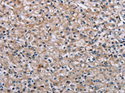 The image on the left is immunohistochemistry of paraffin-embedded Human prostate cancer tissue using CSB-PA698627(PLCL1 Antibody) at dilution 1/40, on the right is treated with synthetic peptide. (Original magnification: ×200)