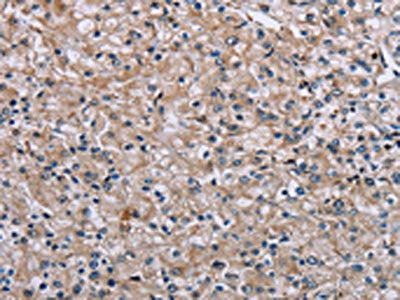 The image on the left is immunohistochemistry of paraffin-embedded Human prostate cancer tissue using CSB-PA698627(PLCL1 Antibody) at dilution 1/40, on the right is treated with synthetic peptide. (Original magnification: ×200)