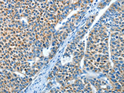 The image on the left is immunohistochemistry of paraffin-embedded Human liver cancer tissue using CSB-PA698673(ADRA1B Antibody) at dilution 1/25, on the right is treated with synthetic peptide. (Original magnification: ×200)