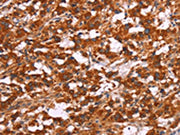 The image on the left is immunohistochemistry of paraffin-embedded Human thyroid cancer tissue using CSB-PA698728(ARPC4 Antibody) at dilution 1/15, on the right is treated with synthetic peptide. (Original magnification: ×200)
