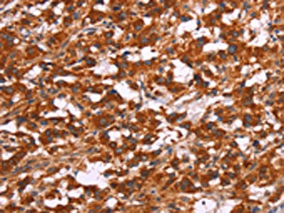 The image on the left is immunohistochemistry of paraffin-embedded Human thyroid cancer tissue using CSB-PA698728(ARPC4 Antibody) at dilution 1/15, on the right is treated with synthetic peptide. (Original magnification: ×200)