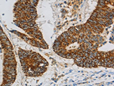 The image on the left is immunohistochemistry of paraffin-embedded Human colon cancer tissue using CSB-PA698741(CCNF Antibody) at dilution 1/20, on the right is treated with fusion protein. (Original magnification: ×200)