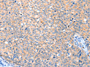 The image on the left is immunohistochemistry of paraffin-embedded Human cervical cancer tissue using CSB-PA698804(VANGL1 Antibody) at dilution 1/20, on the right is treated with fusion protein. (Original magnification: ×200)