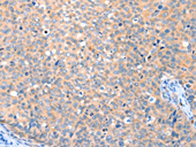 The image on the left is immunohistochemistry of paraffin-embedded Human cervical cancer tissue using CSB-PA698804(VANGL1 Antibody) at dilution 1/20, on the right is treated with fusion protein. (Original magnification: ×200)