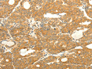 The image on the left is immunohistochemistry of paraffin-embedded Human thyroid cancer tissue using CSB-PA698932(SOX2 Antibody) at dilution 1/25, on the right is treated with fusion protein. (Original magnification: ×200)