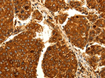 The image on the left is immunohistochemistry of paraffin-embedded Human liver cancer tissue using CSB-PA699120(MAP1LC3A Antibody) at dilution 1/25, on the right is treated with fusion protein. (Original magnification: ×200)