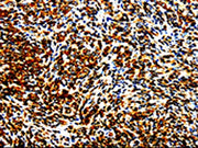 The image is immunohistochemistry of paraffin-embedded Human lymphoma tissue using CSB-PA699319(STAT5B Antibody) at dilution 1/10. (Original magnification: ×200)