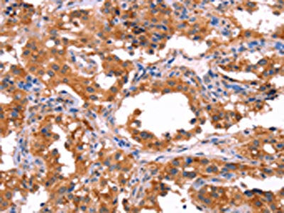 The image on the left is immunohistochemistry of paraffin-embedded Human thyroid cancer tissue using CSB-PA699373(ERAS Antibody) at dilution 1/40, on the right is treated with synthetic peptide. (Original magnification: ×200)