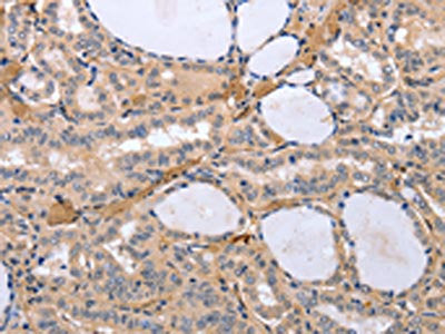 The image on the left is immunohistochemistry of paraffin-embedded Human thyroid cancer tissue using CSB-PA699424(TYROBP Antibody) at dilution 1/30, on the right is treated with synthetic peptide. (Original magnification: ×200)