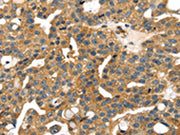 The image on the left is immunohistochemistry of paraffin-embedded Human breast cancer tissue using CSB-PA699439(SMYD4 Antibody) at dilution 1/30, on the right is treated with fusion protein. (Original magnification: ×200)
