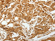 The image on the left is immunohistochemistry of paraffin-embedded Human lung cancer tissue using CSB-PA699479(TGFBR1 Antibody) at dilution 1/60, on the right is treated with synthetic peptide. (Original magnification: ×200)