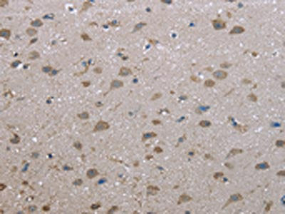 The image on the left is immunohistochemistry of paraffin-embedded Human brain tissue using CSB-PA699536(FAP Antibody) at dilution 1/30, on the right is treated with fusion protein. (Original magnification: ×200)