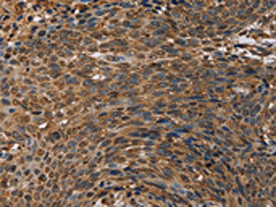The image on the left is immunohistochemistry of paraffin-embedded Human cervical cancer tissue using CSB-PA699624(HIF1AN Antibody) at dilution 1/20, on the right is treated with synthetic peptide. (Original magnification: ×200)