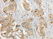 The image on the left is immunohistochemistry of paraffin-embedded Human breast cancer tissue using CSB-PA699938(MMP9 Antibody) at dilution 1/20, on the right is treated with fusion protein. (Original magnification: ×200)