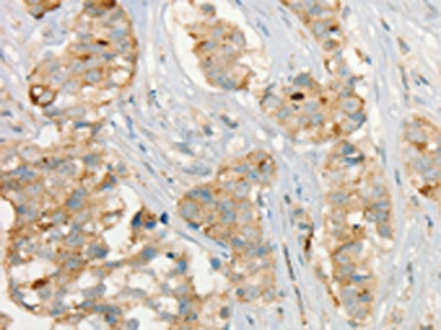 The image on the left is immunohistochemistry of paraffin-embedded Human breast cancer tissue using CSB-PA699938(MMP9 Antibody) at dilution 1/20, on the right is treated with fusion protein. (Original magnification: ×200)