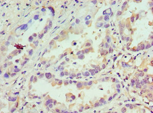 Immunohistochemistry of paraffin-embedded human lung cancer using CSB-PA700653ESR2HU at dilution of 1: 100