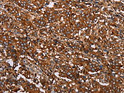 The image on the left is immunohistochemistry of paraffin-embedded Human liver cancer tissue using CSB-PA701502(MFAP5 Antibody) at dilution 1/40, on the right is treated with synthetic peptide. (Original magnification: ×200)