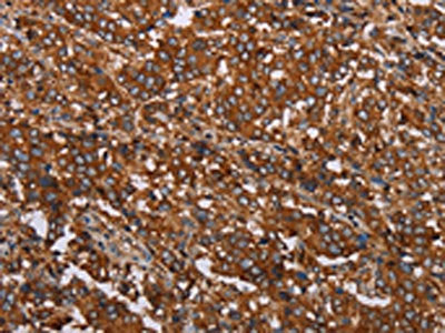The image on the left is immunohistochemistry of paraffin-embedded Human liver cancer tissue using CSB-PA701502(MFAP5 Antibody) at dilution 1/40, on the right is treated with synthetic peptide. (Original magnification: ×200)