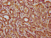 IHC image of CSB-PA703583LA01HU diluted at 1:200 and staining in paraffin-embedded human liver cancer performed on a Leica BondTM system. After dewaxing and hydration, antigen retrieval was mediated by high pressure in a citrate buffer (pH 6.0). S...