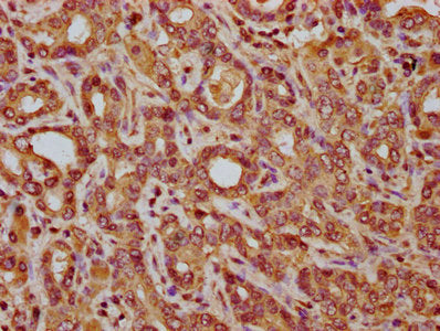 IHC image of CSB-PA703583LA01HU diluted at 1:200 and staining in paraffin-embedded human liver cancer performed on a Leica BondTM system. After dewaxing and hydration, antigen retrieval was mediated by high pressure in a citrate buffer (pH 6.0). S...