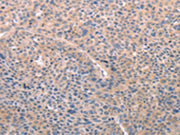 The image on the left is immunohistochemistry of paraffin-embedded Human liver cancer tissue using CSB-PA703896(A4GNT Antibody) at dilution 1/25, on the right is treated with fusion protein. (Original magnification: ×200)