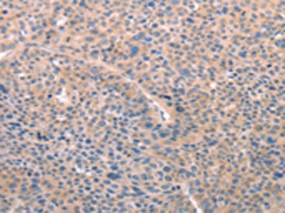 The image on the left is immunohistochemistry of paraffin-embedded Human liver cancer tissue using CSB-PA703896(A4GNT Antibody) at dilution 1/25, on the right is treated with fusion protein. (Original magnification: ×200)