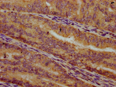 IHC image of CSB-PA704720LA01HU diluted at 1:300 and staining in paraffin-embedded human endometrial cancer performed on a Leica BondTM system. After dewaxing and hydration, antigen retrieval was mediated by high pressure in a citrate buffer (pH 6...