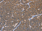 The image on the left is immunohistochemistry of paraffin-embedded Human ovarian cancer tissue using CSB-PA706521(FABP6 Antibody) at dilution 1/30, on the right is treated with fusion protein. (Original magnification: ×200)