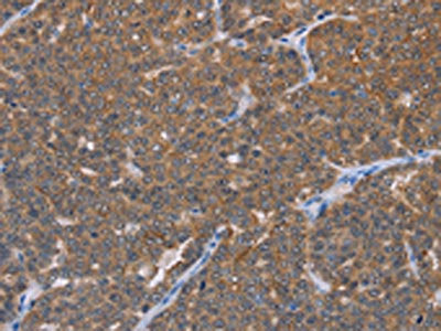 The image on the left is immunohistochemistry of paraffin-embedded Human ovarian cancer tissue using CSB-PA706521(FABP6 Antibody) at dilution 1/30, on the right is treated with fusion protein. (Original magnification: ×200)
