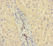 Immunohistochemistry of paraffin-embedded human liver cancer using CSB-PA706632HA01HU at dilution of 1:100