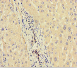 Immunohistochemistry of paraffin-embedded human liver cancer using CSB-PA706632HA01HU at dilution of 1:100