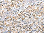 The image on the left is immunohistochemistry of paraffin-embedded Human thyroid cancer tissue using CSB-PA706929(APPBP2 Antibody) at dilution 1/25, on the right is treated with fusion protein. (Original magnification: ×200)