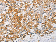 The image on the left is immunohistochemistry of paraffin-embedded Human thyroid cancer tissue using CSB-PA707391(ARMCX3 Antibody) at dilution 1/40, on the right is treated with fusion protein. (Original magnification: ×200)