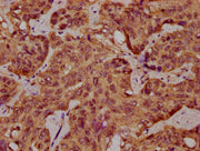 IHC image of CSB-PA707717LA01HU diluted at 1:400 and staining in paraffin-embedded human liver cancer performed on a Leica BondTM system. After dewaxing and hydration, antigen retrieval was mediated by high pressure in a citrate buffer (pH 6.0). S...