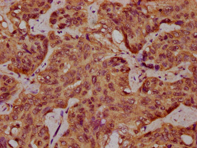IHC image of CSB-PA707717LA01HU diluted at 1:400 and staining in paraffin-embedded human liver cancer performed on a Leica BondTM system. After dewaxing and hydration, antigen retrieval was mediated by high pressure in a citrate buffer (pH 6.0). S...