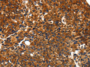 The image on the left is immunohistochemistry of paraffin-embedded Human breast cancer tissue using CSB-PA708217(CMTM3 Antibody) at dilution 1/10, on the right is treated with synthetic peptide. (Original magnification: ×200)