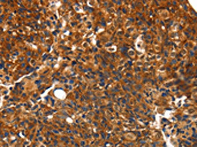 The image on the left is immunohistochemistry of paraffin-embedded Human breast cancer tissue using CSB-PA708217(CMTM3 Antibody) at dilution 1/10, on the right is treated with synthetic peptide. (Original magnification: ×200)