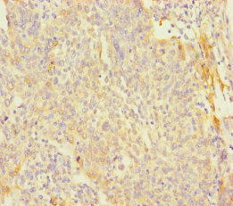 Immunohistochemistry of paraffin-embedded human cervical cancer using CSB-PA708481LA01HU at dilution of 1:100