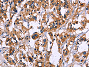 The image on the left is immunohistochemistry of paraffin-embedded Human thyroid cancer tissue using CSB-PA708659(ZEB2 Antibody) at dilution 1/60, on the right is treated with fusion protein. (Original magnification: ×200)